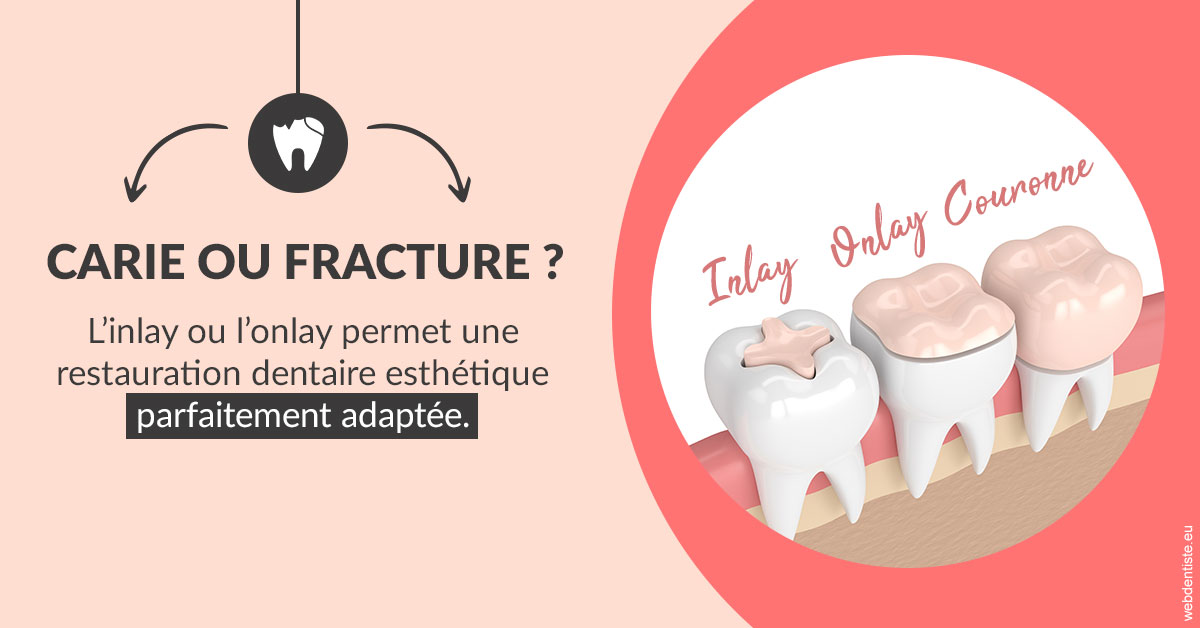 https://dr-francisci-mc.chirurgiens-dentistes.fr/T2 2023 - Carie ou fracture 2
