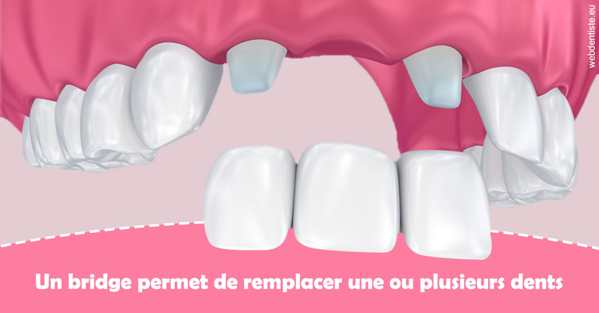 https://dr-francisci-mc.chirurgiens-dentistes.fr/Bridge remplacer dents 2