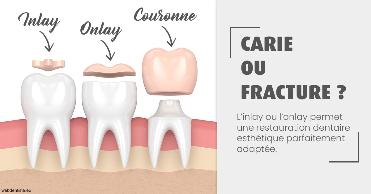 https://dr-francisci-mc.chirurgiens-dentistes.fr/T2 2023 - Carie ou fracture 1