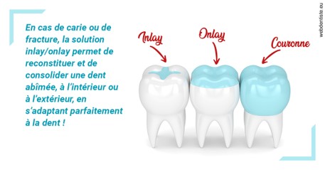 https://dr-francisci-mc.chirurgiens-dentistes.fr/L'INLAY ou l'ONLAY