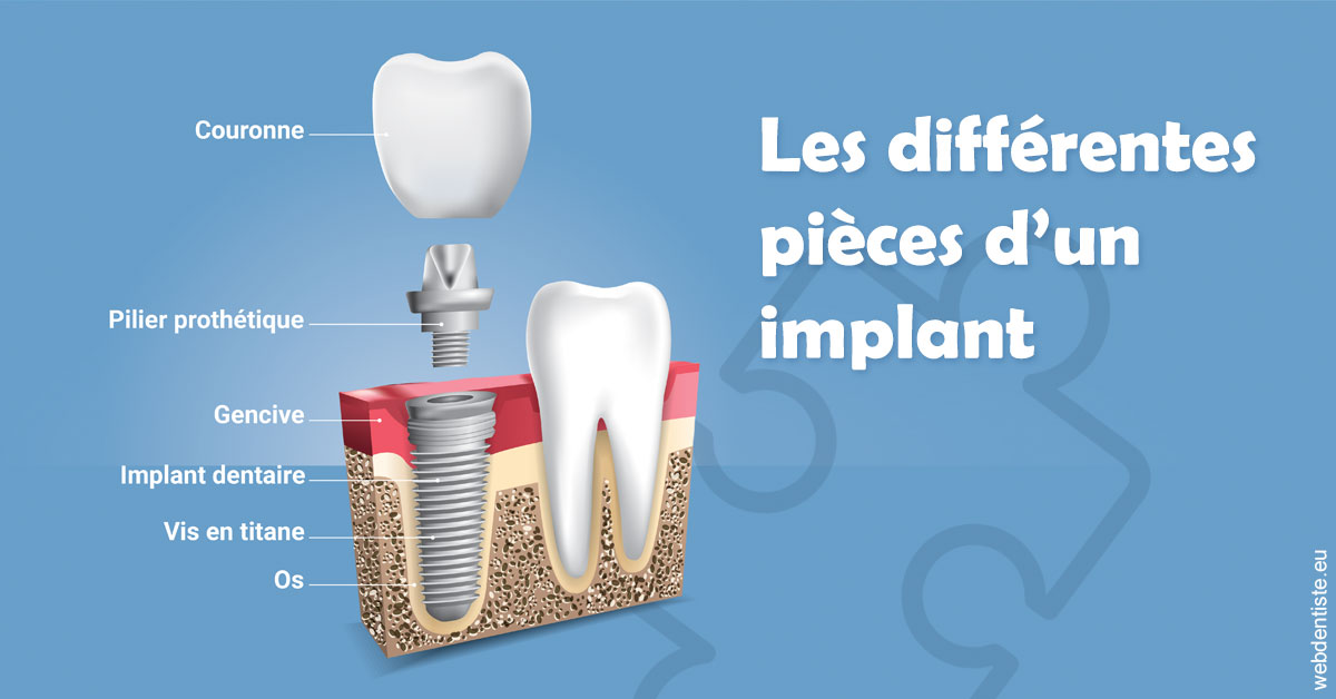https://dr-francisci-mc.chirurgiens-dentistes.fr/Les différentes pièces d’un implant 1
